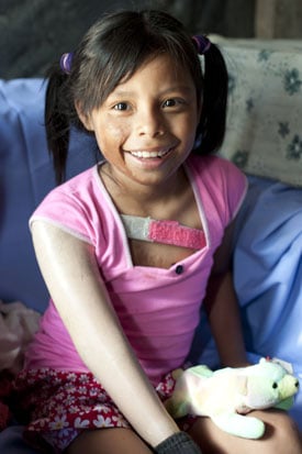 smiling girl with burns on her face and wearing a prosthesis