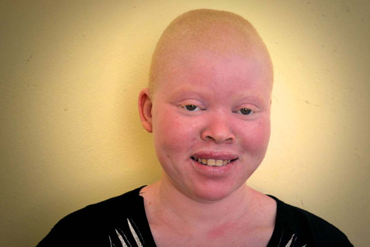 Albinism in Tanzania Grace