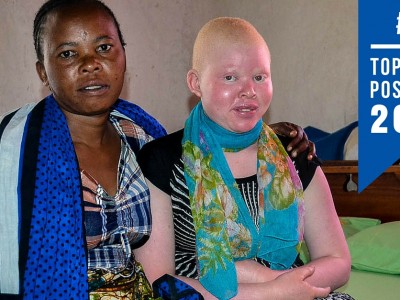 Albinism in Tanzania top blogs 2015