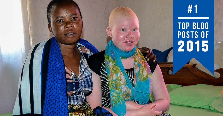 Albinism in Tanzania top blogs 2015