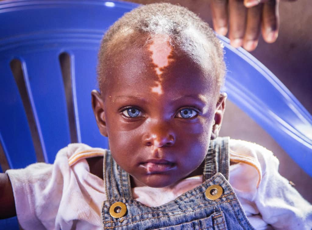 An up-close photo of a Ugandan boy with blue eyes and a white stripe of skin down his forehead.