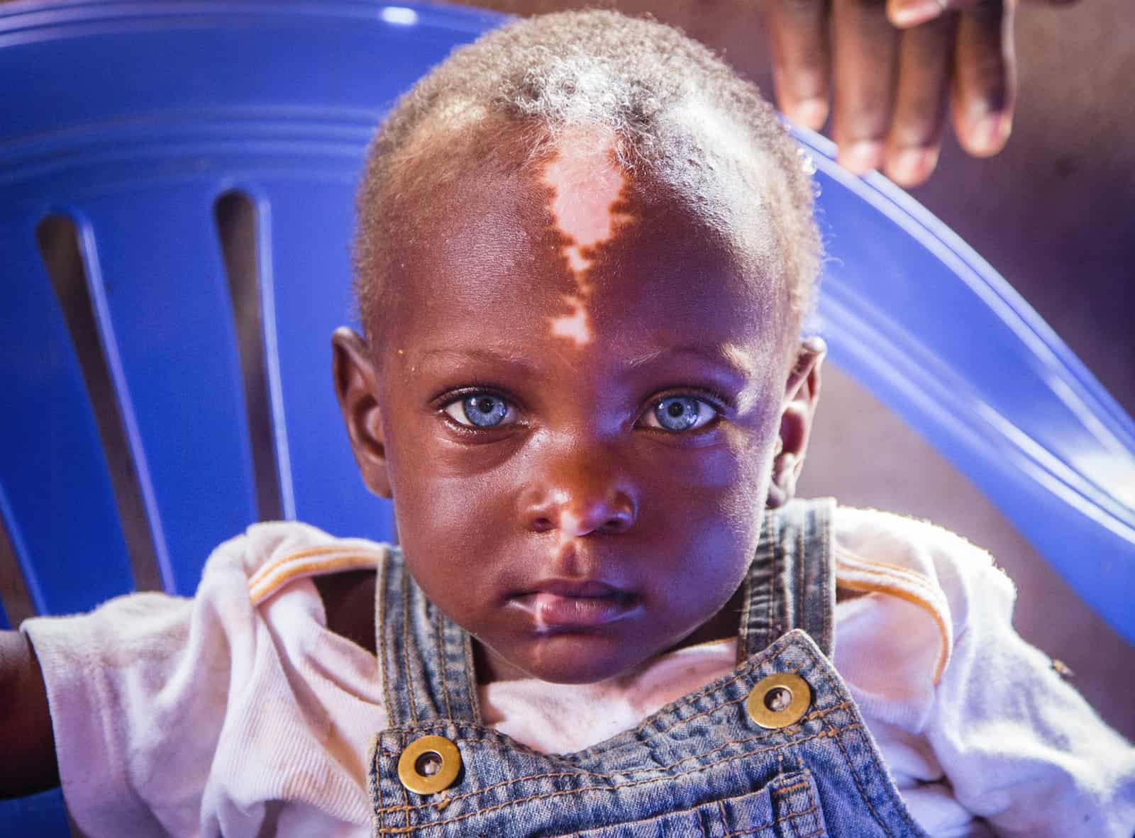 Little boy with bright blue eyes and striking patches of white adorning his face looks into the camera