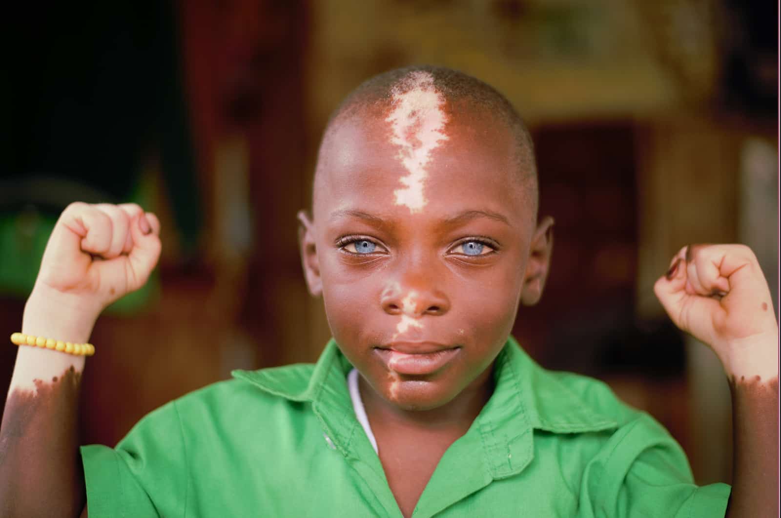 Waardenburg Syndrome picture: A boy with blue eyes and partial albinism, holding his arms up to show he is strong.