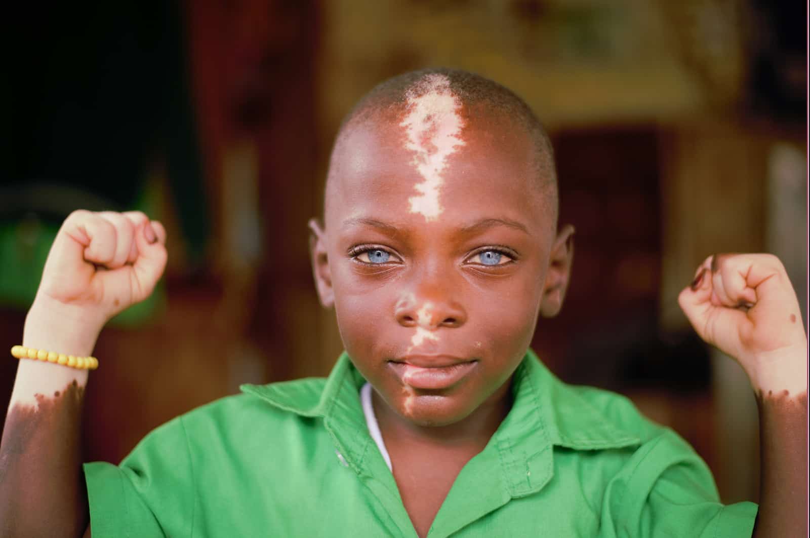 Waardenburg Syndrome: Shakul & His Striking Blue Eyes