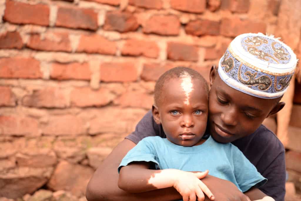Waardenburg Syndrome: Shakul & His Striking Blue Eyes