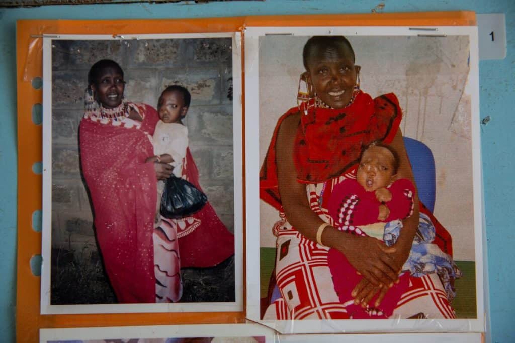 Two photos of a Kenyan woman in brightly colored clothing holding a baby with nasal encephalocele.